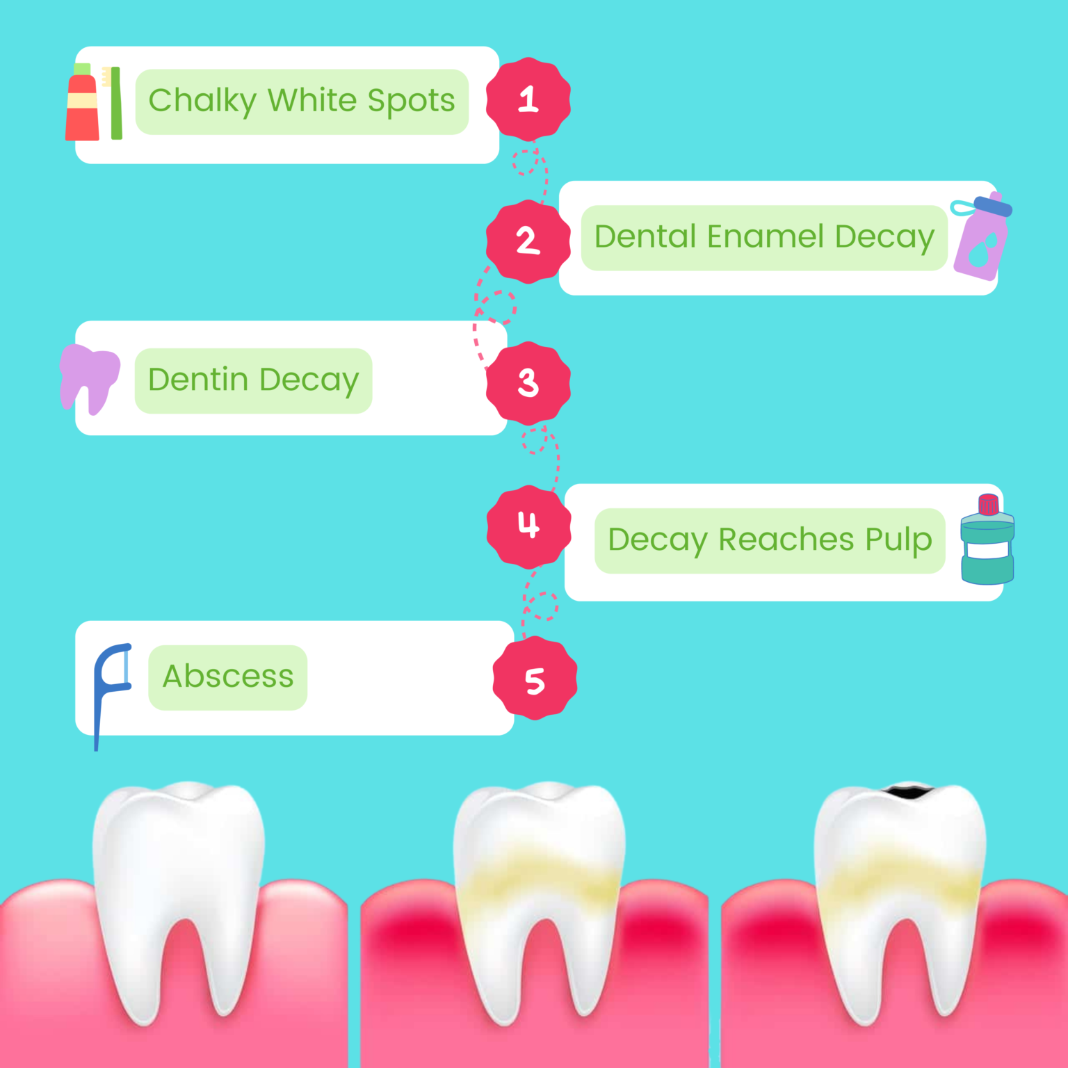 Stages of Tooth Decay Fountainview Dental
